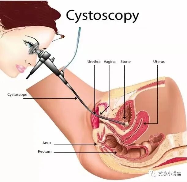 b膀胱镜为什么消毒什么是膀胱镜检查_https://www.jmylbn.com_新闻资讯_第4张