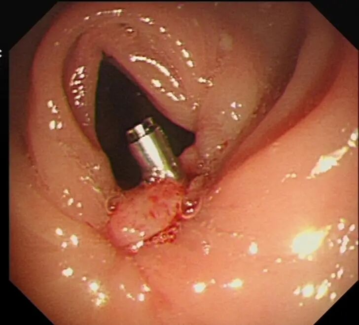 圈套器品牌有哪些品牌技术 ｜ 肛门保卫战—ESD手术带来福音_https://www.jmylbn.com_新闻资讯_第15张