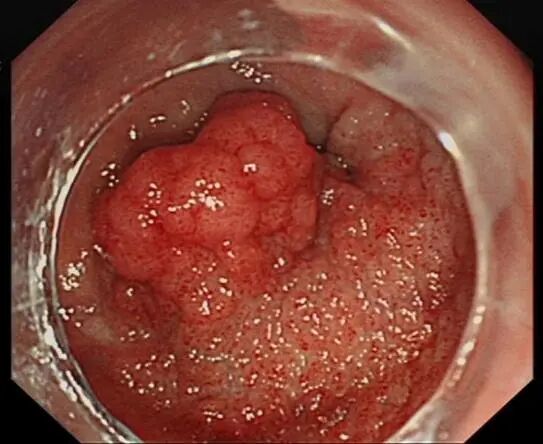 圈套器品牌有哪些品牌技术 ｜ 肛门保卫战—ESD手术带来福音_https://www.jmylbn.com_新闻资讯_第3张