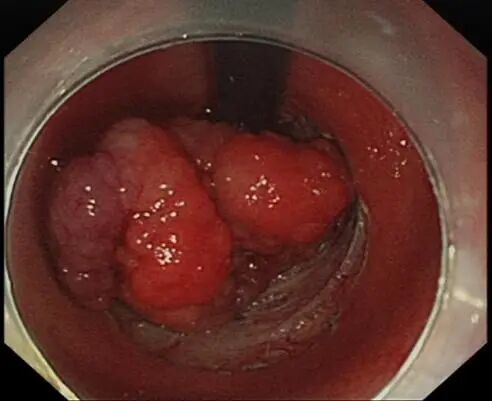 圈套器品牌有哪些品牌技术 ｜ 肛门保卫战—ESD手术带来福音_https://www.jmylbn.com_新闻资讯_第11张