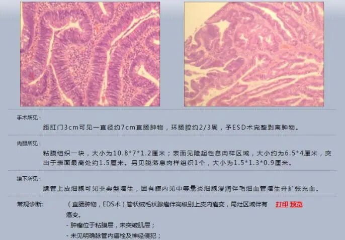 圈套器品牌有哪些品牌技术 ｜ 肛门保卫战—ESD手术带来福音_https://www.jmylbn.com_新闻资讯_第13张