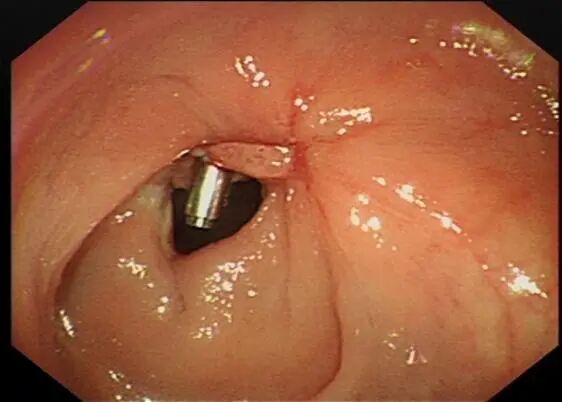 圈套器品牌有哪些品牌技术 ｜ 肛门保卫战—ESD手术带来福音_https://www.jmylbn.com_新闻资讯_第14张