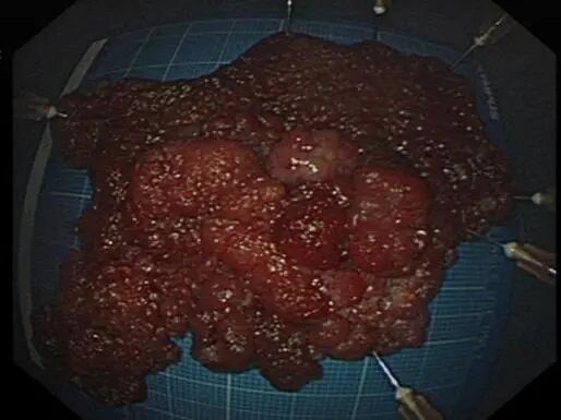 圈套器品牌有哪些品牌技术 ｜ 肛门保卫战—ESD手术带来福音_https://www.jmylbn.com_新闻资讯_第12张