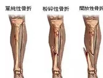体检dr是什么意思【傻傻分不清楚】DR、CT、彩超，体检中哪一项才是最佳选择？一分钟读懂！_https://www.jmylbn.com_新闻资讯_第14张