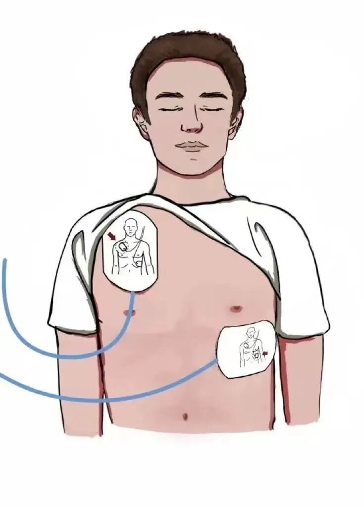 aed电极贴怎么贴红科普 ｜ 如何正确使用AED？_https://www.jmylbn.com_新闻资讯_第10张