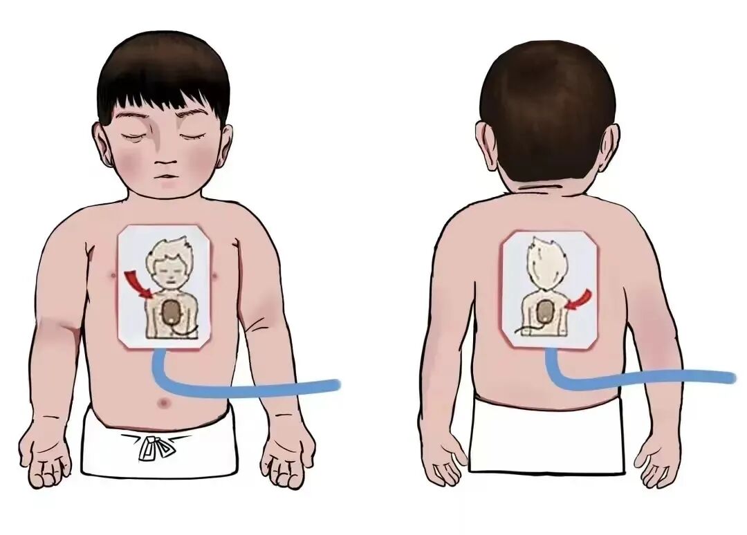 aed电极贴怎么贴人人都学习丨AED如何使用？_https://www.jmylbn.com_新闻资讯_第3张
