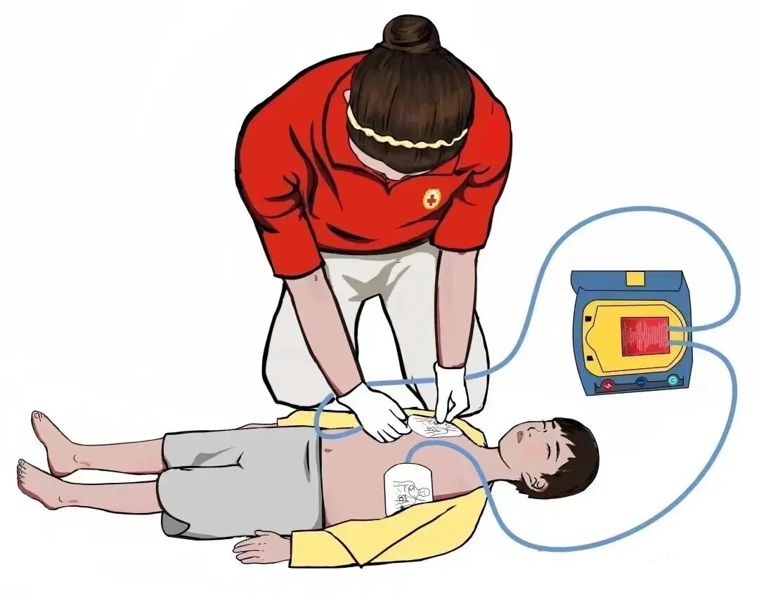 aed电极贴怎么贴人人都学习丨AED如何使用？_https://www.jmylbn.com_新闻资讯_第4张