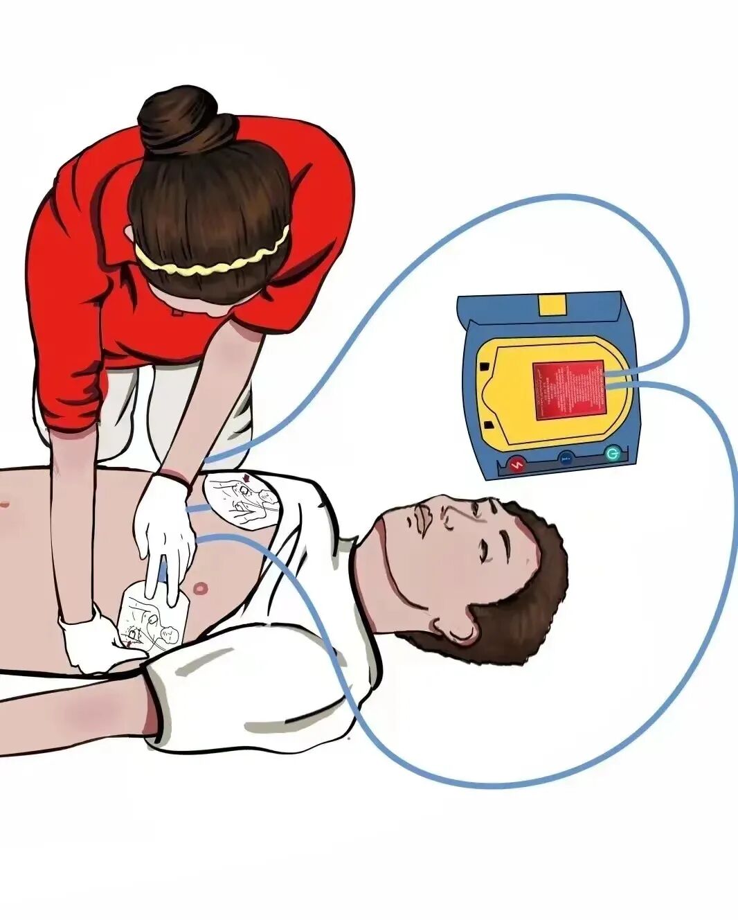 aed电极贴怎么贴红科普 ｜ 如何正确使用AED？_https://www.jmylbn.com_新闻资讯_第11张