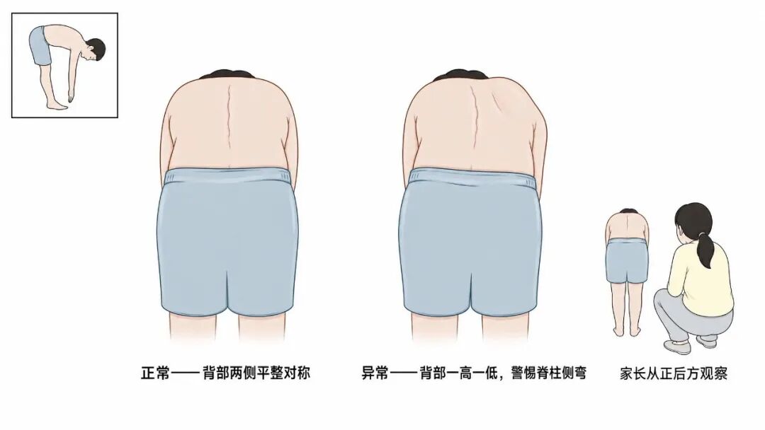 脊柱侧弯自查示意图.jpg