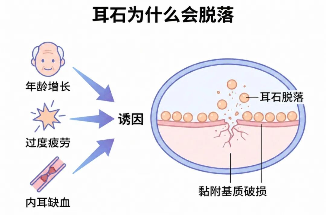 生成耳石症科普插图 (2).jpg