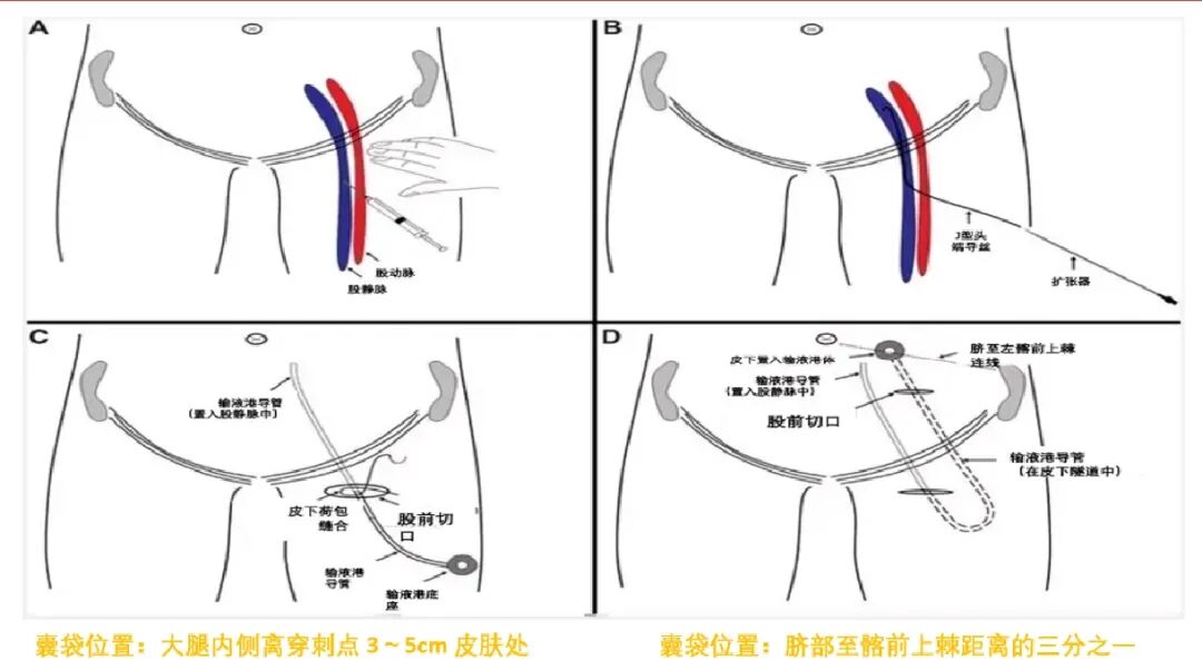 电子输注泵起什么作用输液港只能静脉输液吗？它用途可大了！_https://www.jmylbn.com_新闻资讯_第3张