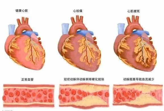 心肌三合一是什么南喃有声·检验知不知丨冬春交替警惕心梗_https://www.jmylbn.com_新闻资讯_第3张