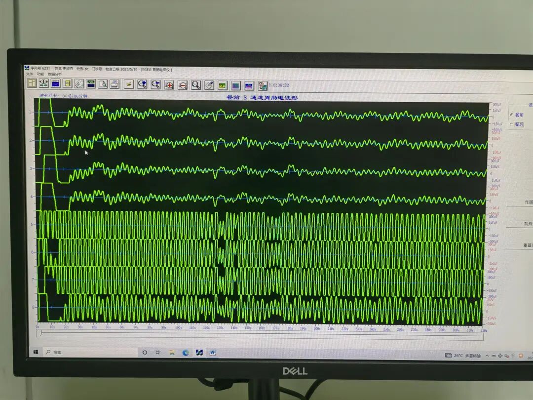 肠电图能查看什么【杏林科普】胃肠动力问题别着急，胃肠电图检查来帮您_https://www.jmylbn.com_新闻资讯_第7张