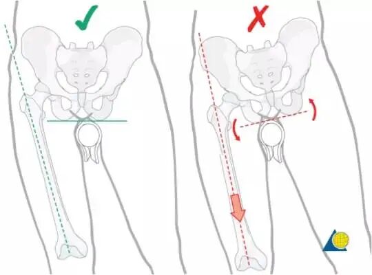 股骨粗隆间骨折PFNA内固定的4大关键总结，实用！