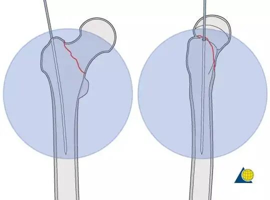 股骨粗隆间骨折PFNA内固定的4大关键总结，实用！