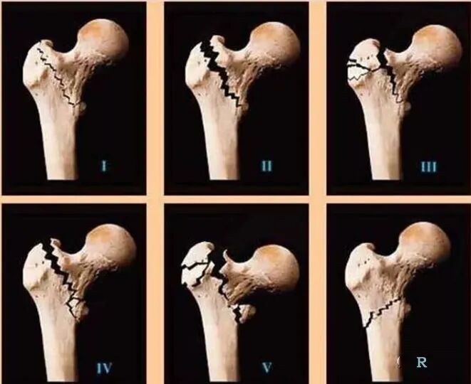 股骨粗隆间骨折PFNA内固定的4大关键总结，实用！