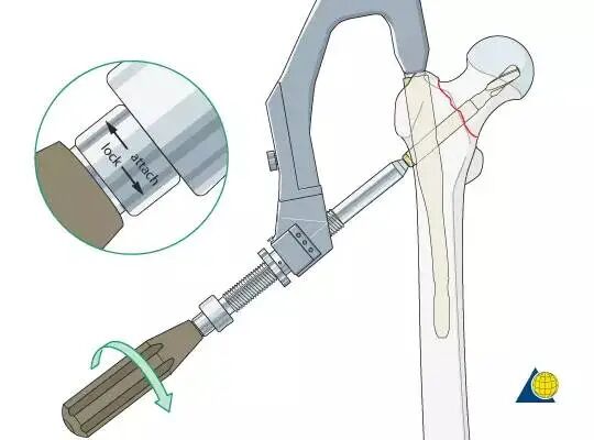 股骨粗隆间骨折PFNA内固定的4大关键总结，实用！