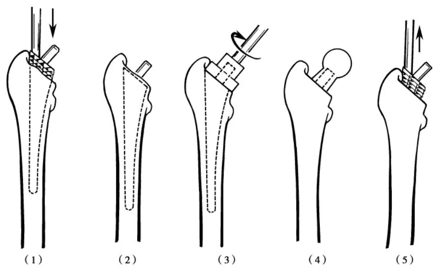 手术技巧：人工髋关节置换术，骨科医生须掌握！