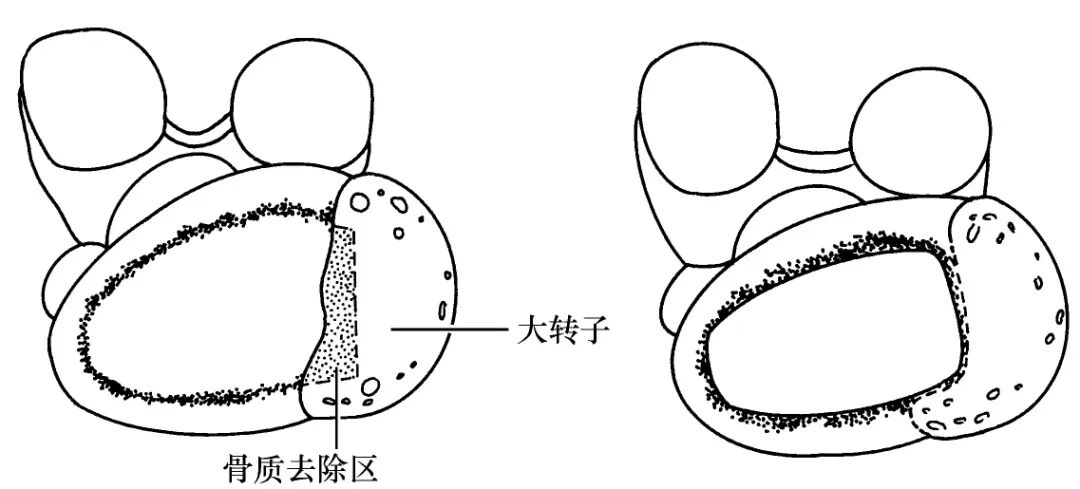 手术技巧：人工髋关节置换术，骨科医生须掌握！