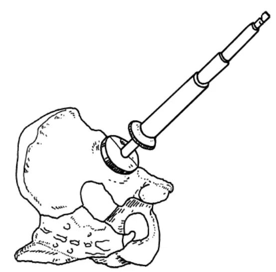 手术技巧：人工髋关节置换术，骨科医生须掌握！