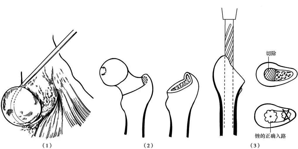 手术技巧：人工髋关节置换术，骨科医生须掌握！