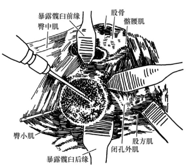 手术技巧：人工髋关节置换术，骨科医生须掌握！