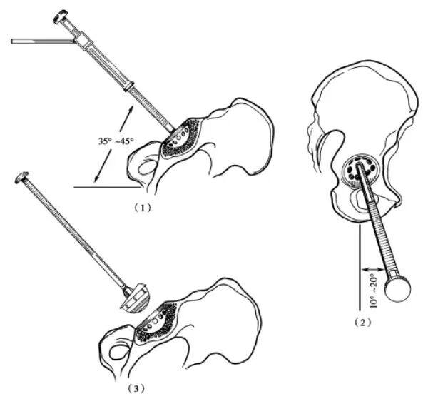 手术技巧：人工髋关节置换术，骨科医生须掌握！