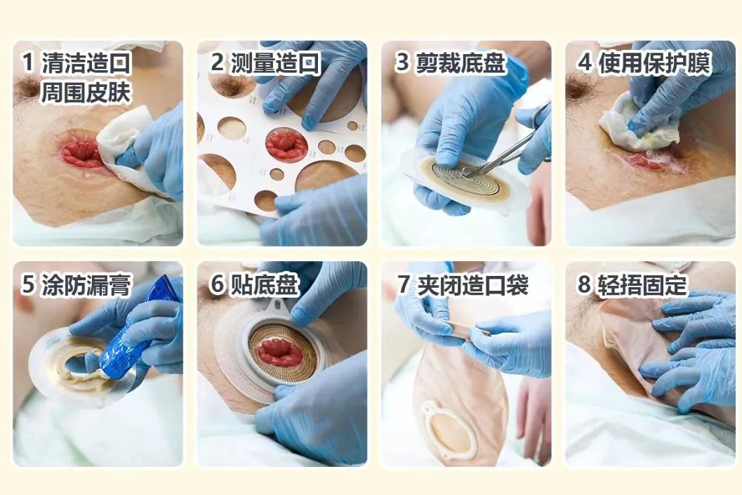 【便民服务】宁阳县一院伤口造口,静脉治疗专科护理门诊