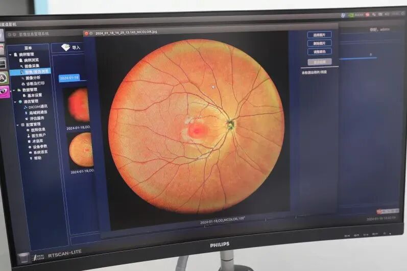 眼底激光机有什么牌子【特色诊疗】免散瞳、成像快，这种“相机”让眼底病变无所遁形_https://www.jmylbn.com_新闻资讯_第6张