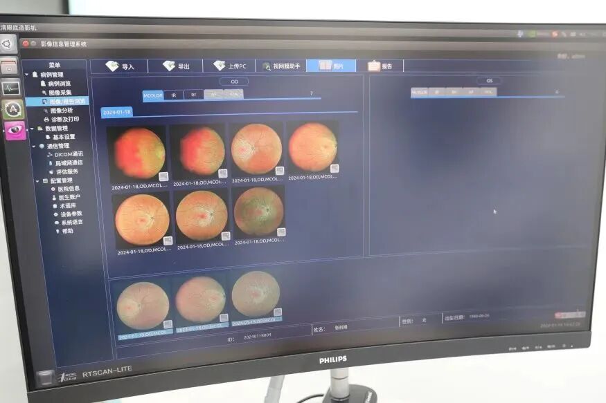 眼底激光机有什么牌子【特色诊疗】免散瞳、成像快，这种“相机”让眼底病变无所遁形_https://www.jmylbn.com_新闻资讯_第9张