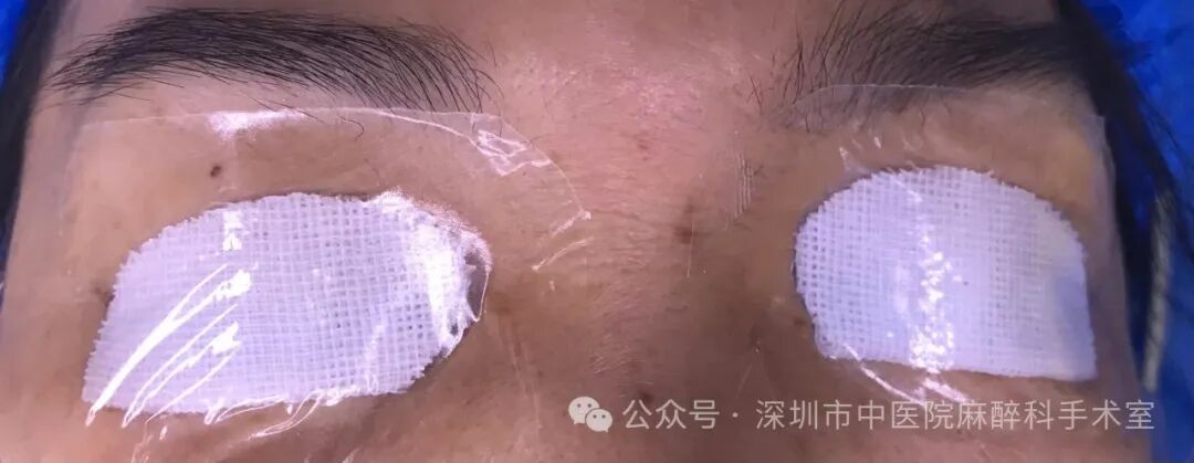 纱布片怎么使用方法巧用无菌脑棉片，让全麻手术患者的眼保护更安全_https://www.jmylbn.com_新闻资讯_第3张