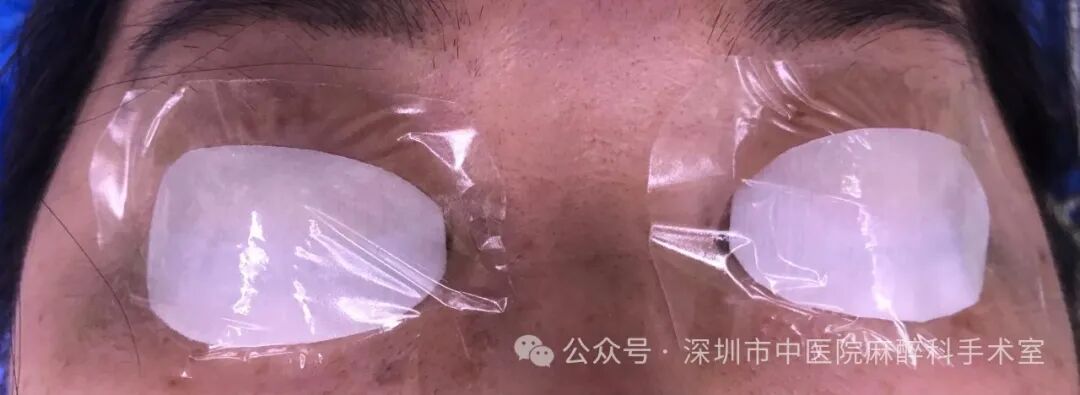 纱布片怎么使用方法巧用无菌脑棉片，让全麻手术患者的眼保护更安全_https://www.jmylbn.com_新闻资讯_第4张