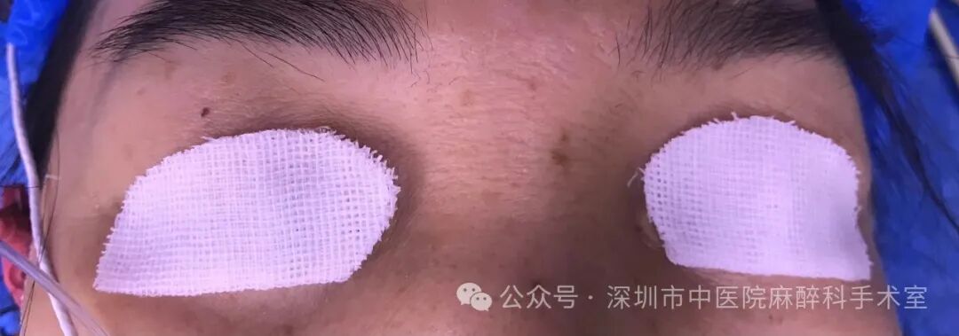 纱布片怎么使用方法巧用无菌脑棉片，让全麻手术患者的眼保护更安全_https://www.jmylbn.com_新闻资讯_第2张