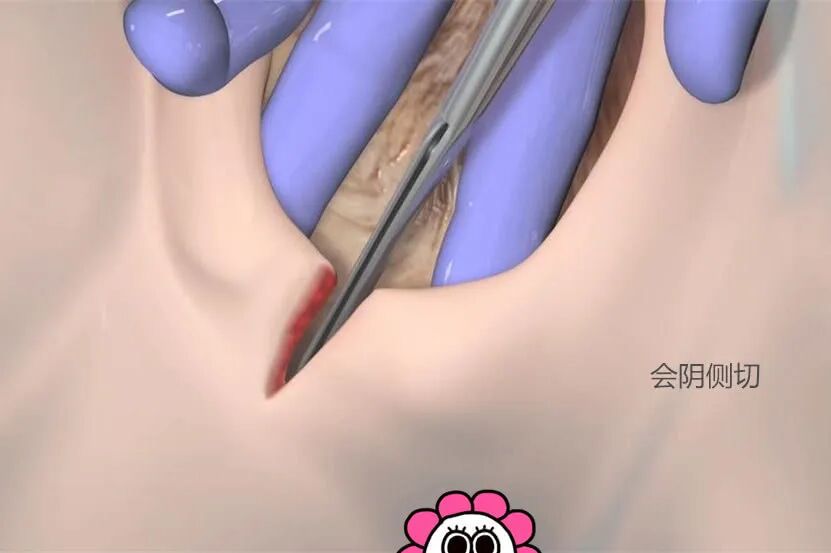 tdp治疗仪怎么用【文献解读】TDP 治疗仪配合依沙吖啶贴敷预防产后会阴切口感染的临床观察_https://www.jmylbn.com_新闻资讯_第1张