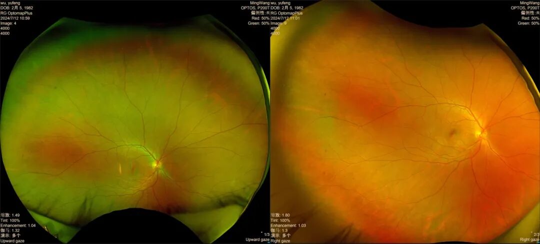 怎么看眼底相机拍一张照片就能看穿眼底病变！庆阳市人民医院引进眼底检查新利器——超广角眼底照相机_https://www.jmylbn.com_新闻资讯_第3张