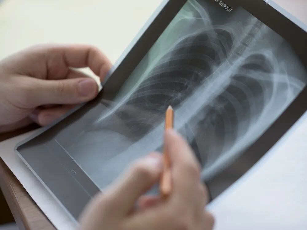 X光拍片为什么要等拍片选X光、CT还是磁共振？听听医生怎么说！_https://www.jmylbn.com_新闻资讯_第7张