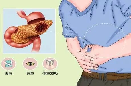 胰腺癌确诊需要做哪些检查，你知道吗？