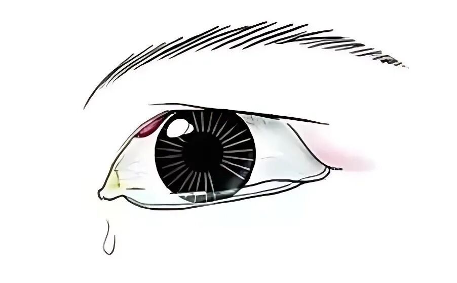 别把“麦粒肿”当痘痘！一男子乱挤险些失明！