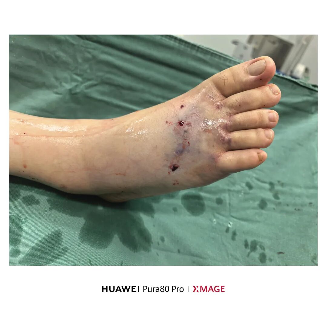 万能克氏针，逆行髓内针，在跖骨骨折中的应用