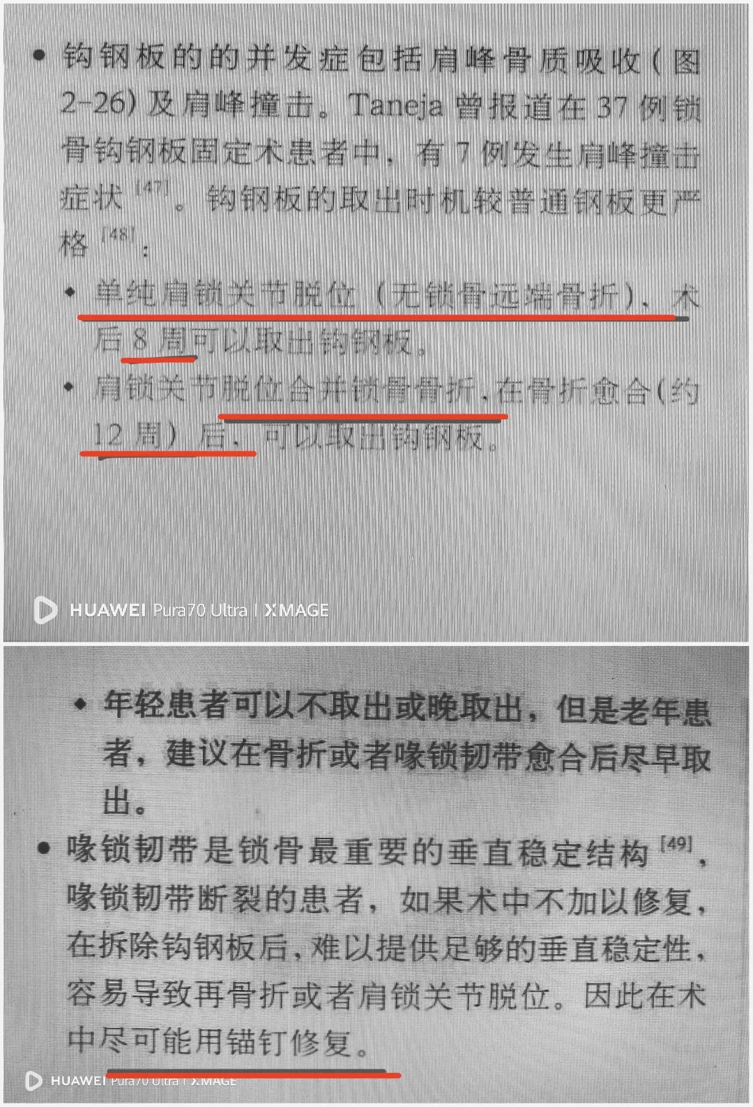 锁骨钩板真的过时了吗？怎么才能避免并发症？