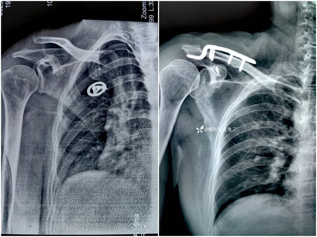 锁骨钩板真的过时了吗？怎么才能避免并发症？