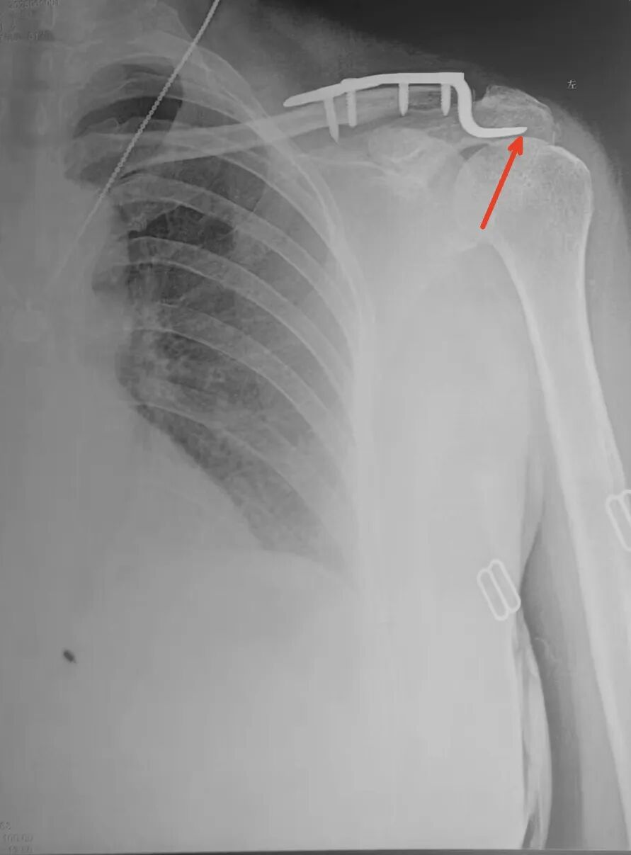 锁骨钩板真的过时了吗？怎么才能避免并发症？