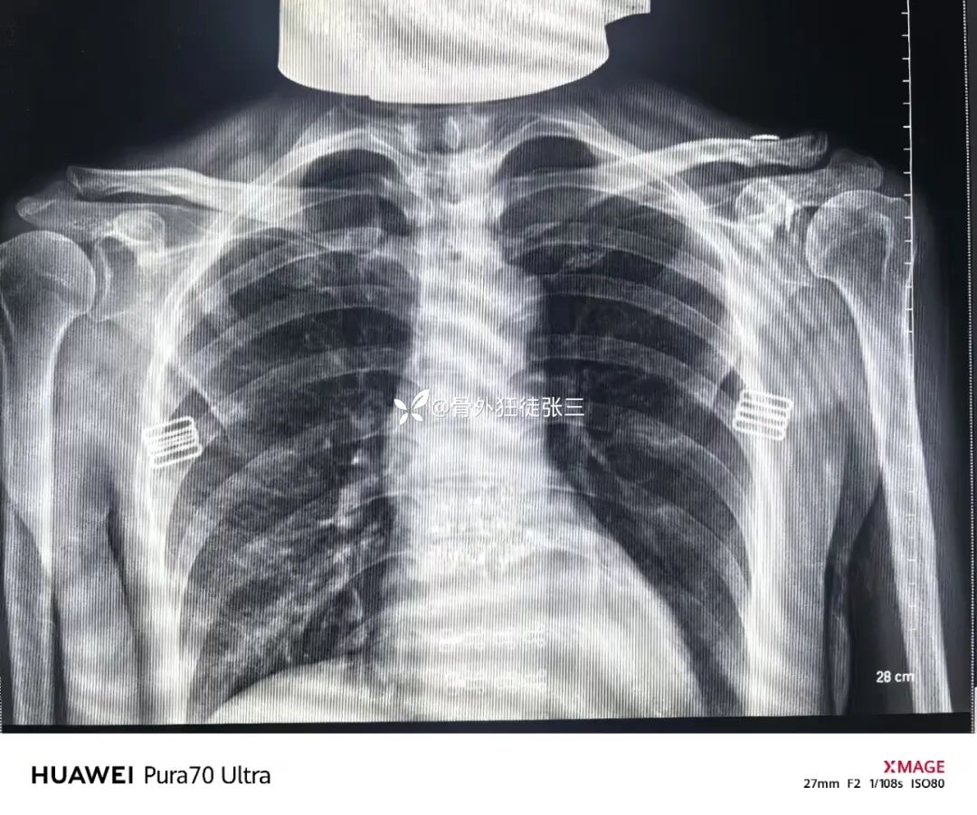 锁骨钩板真的过时了吗？怎么才能避免并发症？