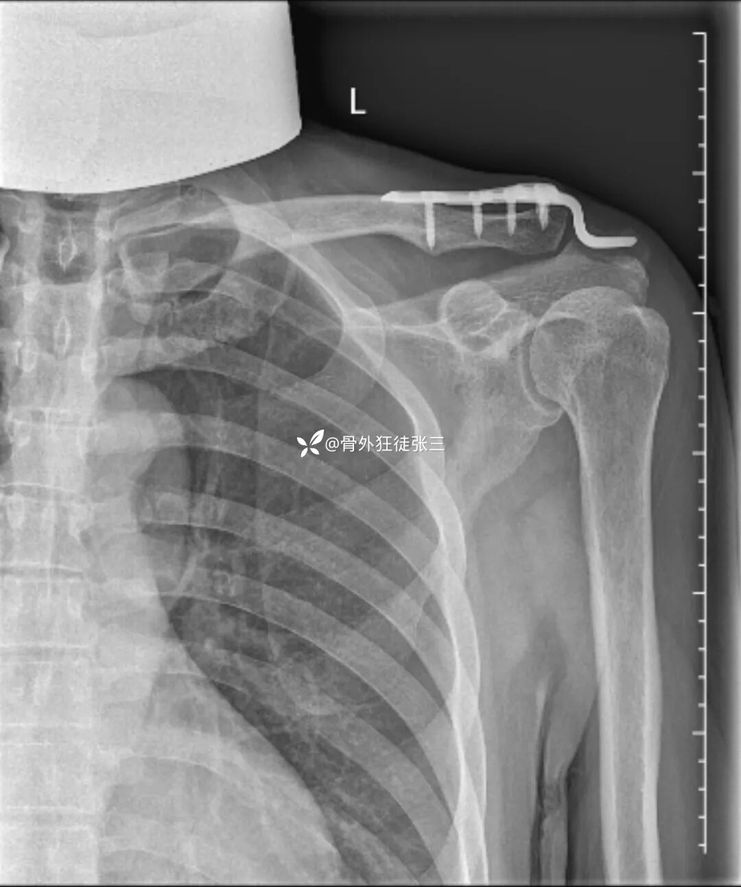 锁骨钩板真的过时了吗？怎么才能避免并发症？