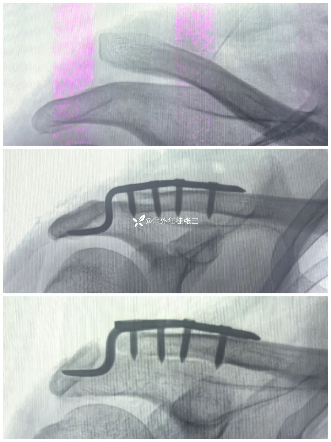 锁骨钩板真的过时了吗？怎么才能避免并发症？