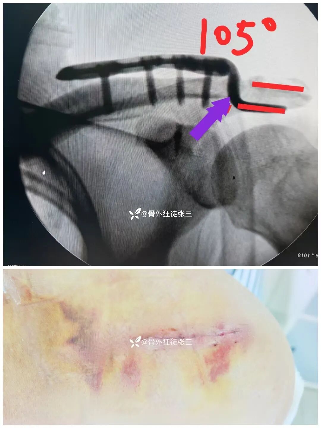 锁骨钩板真的过时了吗？怎么才能避免并发症？