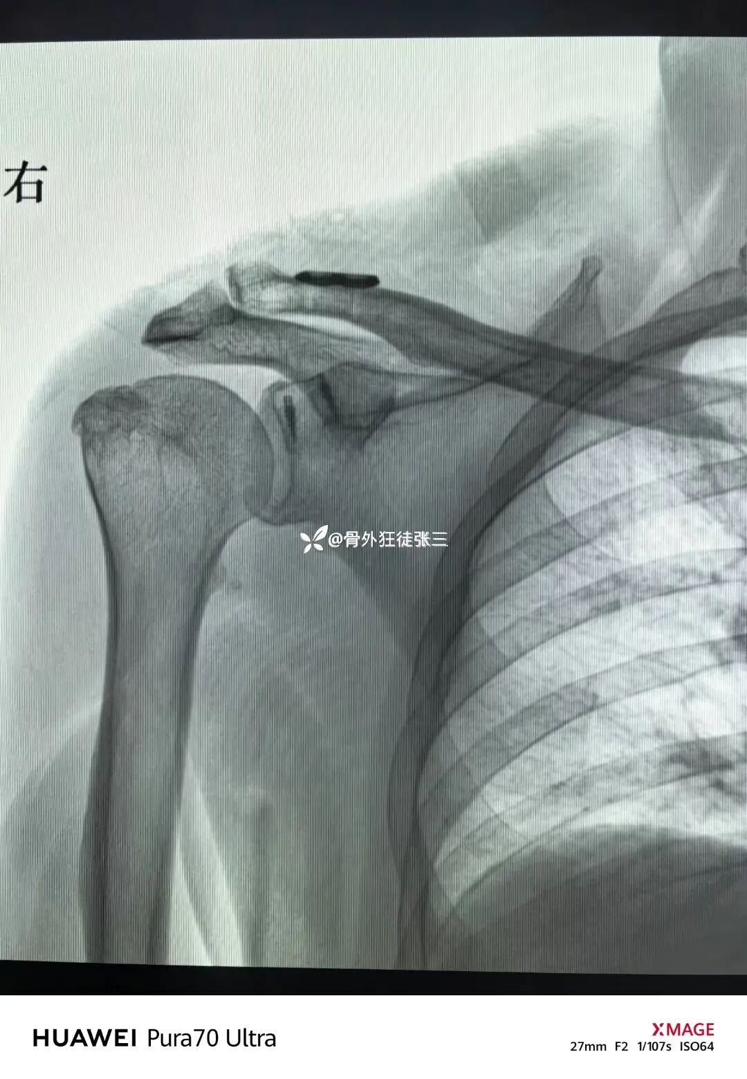 锁骨钩板真的过时了吗？怎么才能避免并发症？