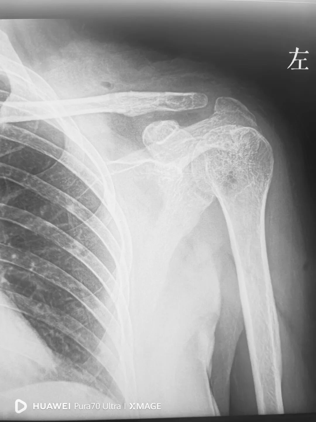 锁骨钩板真的过时了吗？怎么才能避免并发症？