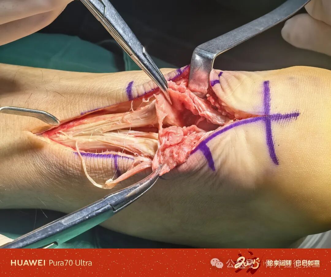 跟腱断裂谁之罪----Haglund综合征，“封闭针”岂能背锅？