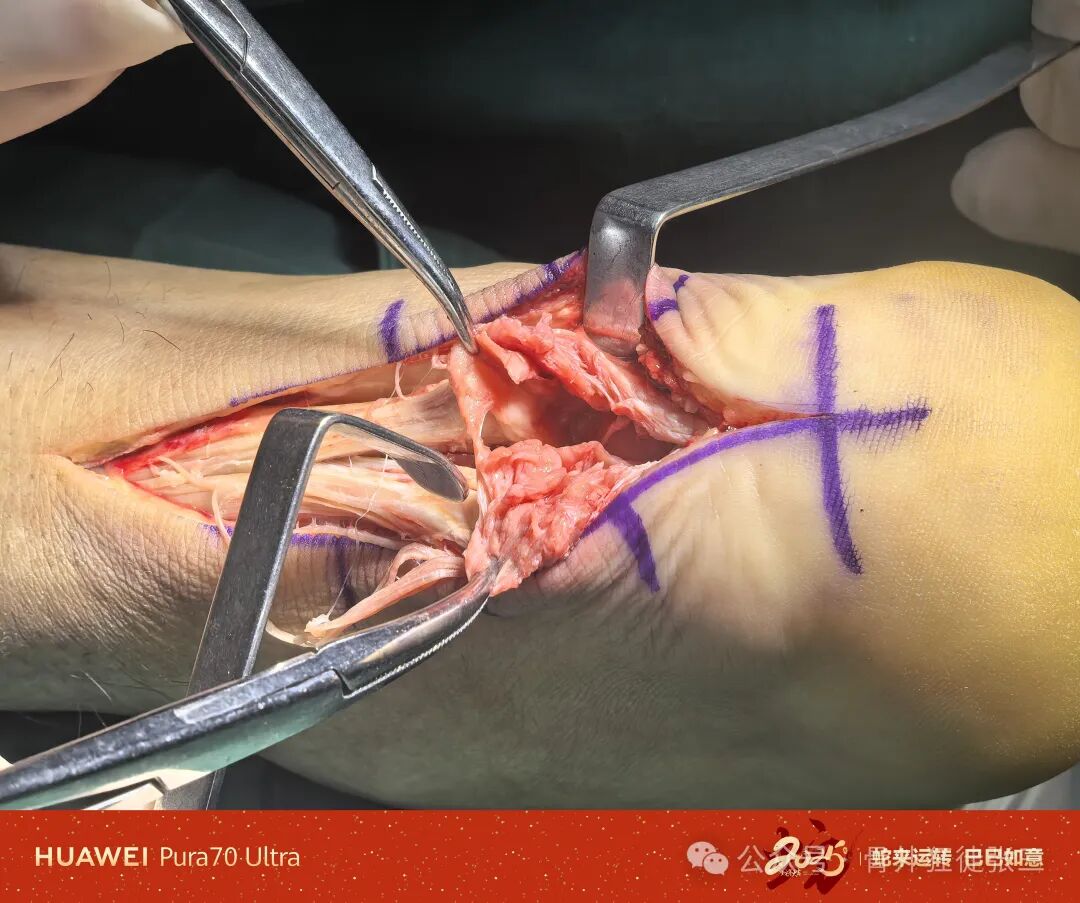 跟腱断裂谁之罪----Haglund综合征，“封闭针”岂能背锅？